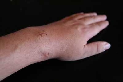 Une montre après un poignet cassé ? Main_frankenstein.thumb